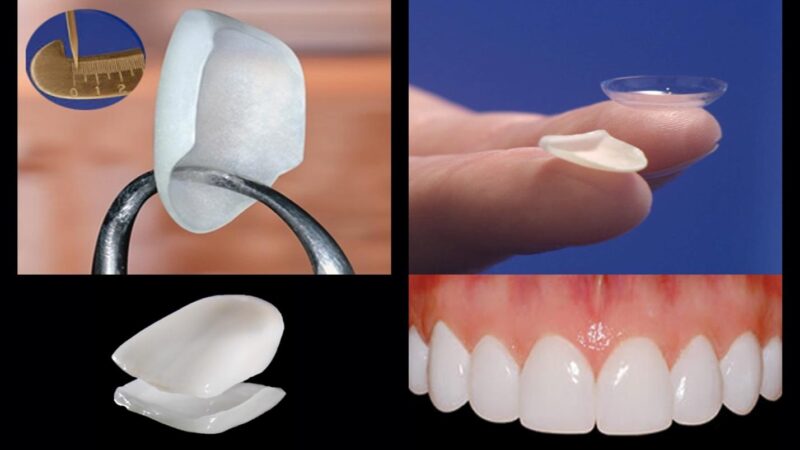 How Does Dental Veneer Work?