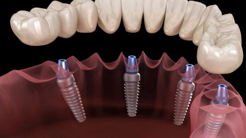 How Is the Dental Implant Process and What to Expect During Recovery?
