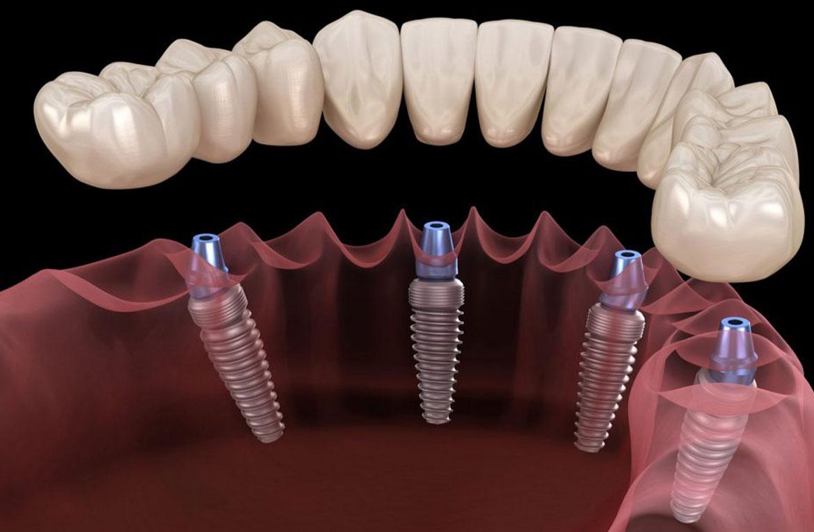How Is the Dental Implant Process and What to Expect During Recovery?