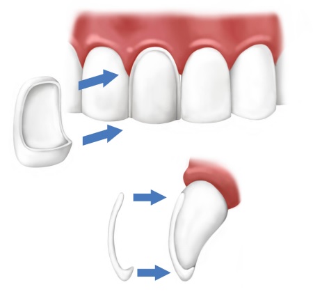 What Are Tooth Veneers and Nerve Extractions?