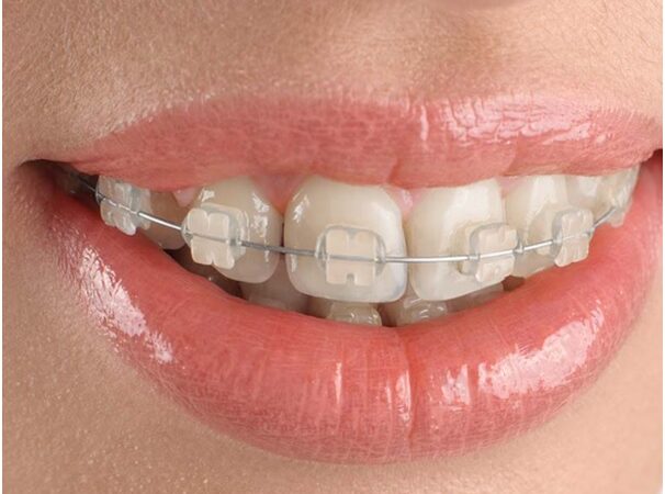 9 Amazing Advantages of Opting for Clear Braces