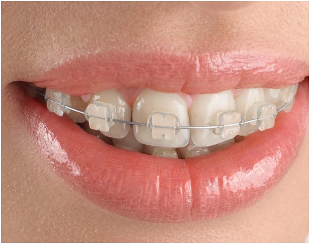 9 Amazing Advantages of Opting for Clear Braces