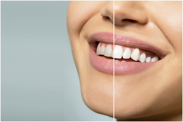 What Are Different Methods of Teeth Whitening? 