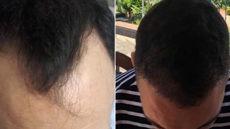 A transplanted head area can make an amazingly clear difference! 