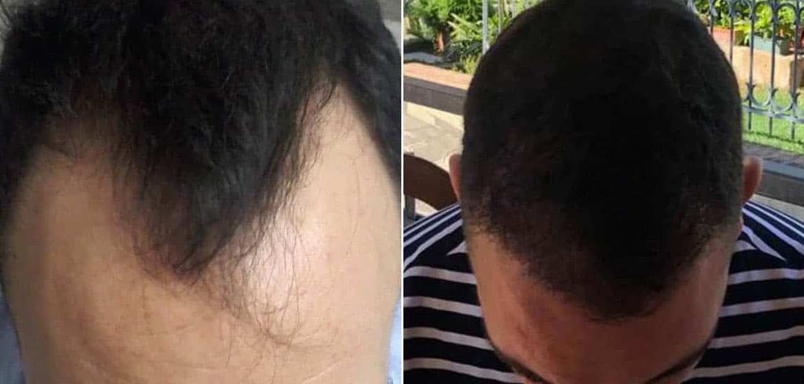 A transplanted head area can make an amazingly clear difference! 