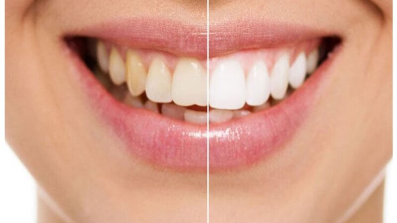 Is Teeth Whitening Good for Me?