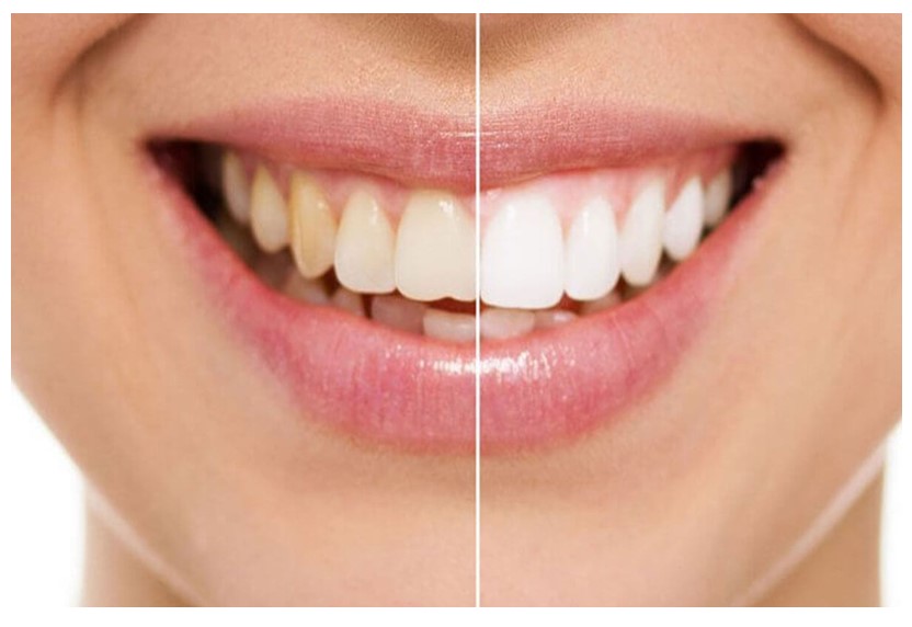 Is Teeth Whitening Good for Me?