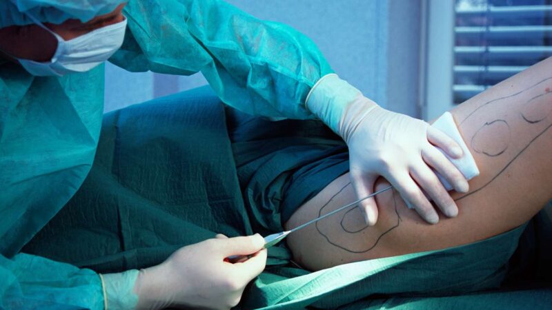 What to Expect During and After Liposuction Surgery?
