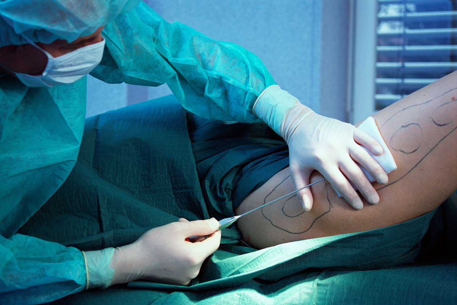 What to Expect During and After Liposuction Surgery?